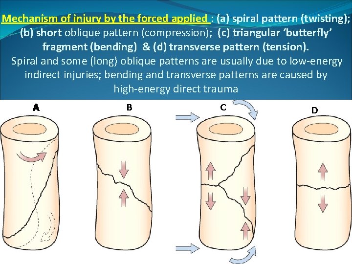 Mechanism of injury by the forced applied : (a) spiral pattern (twisting); (b) short Mechanism of injury by the forced applied : (a) spiral pattern (twisting); (b) short
