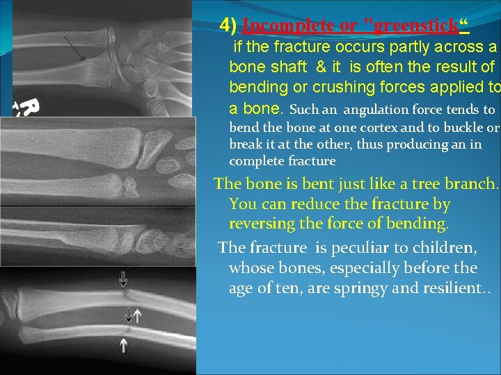 4) Incomplete or "greenstick“ if the fracture occurs partly across a bone shaft & 4) Incomplete or "greenstick“ if the fracture occurs partly across a bone shaft &