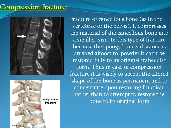 Compression fracture: fracture of cancellous bone (as in the vertebrae or the pelvis). It Compression fracture: fracture of cancellous bone (as in the vertebrae or the pelvis). It