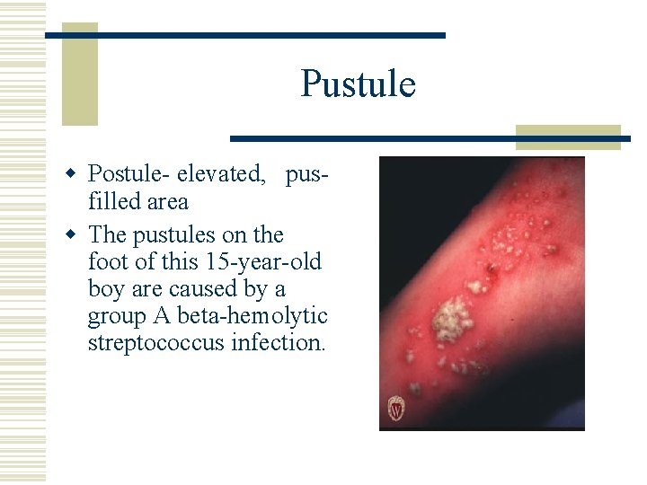 Pustule w Postule- elevated, pusfilled area w The pustules on the foot of this