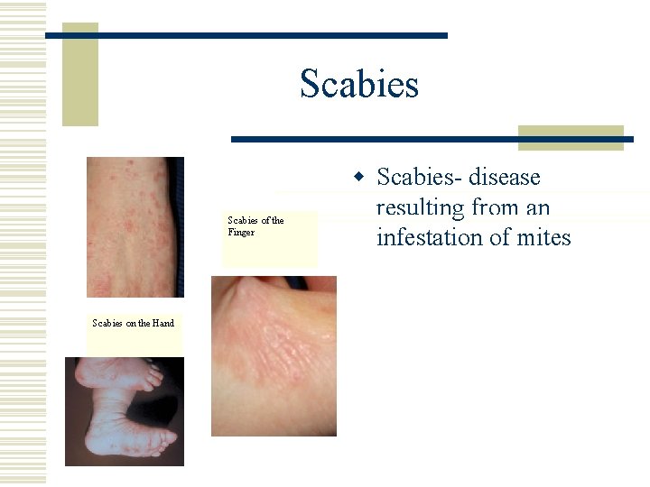 Scabies of the Finger Scabies on the Hand w Scabies- disease resulting from an