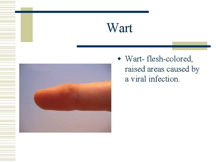 Wart w Wart- flesh-colored, raised areas caused by a viral infection. 