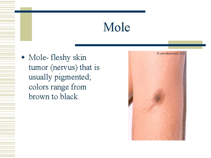 Mole w Mole- fleshy skin tumor (nervus) that is usually pigmented; colors range from