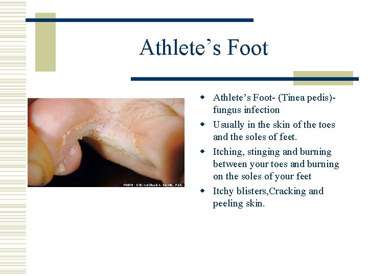 Athlete’s Foot w Athlete’s Foot- (Tinea pedis)fungus infection w Usually in the skin of