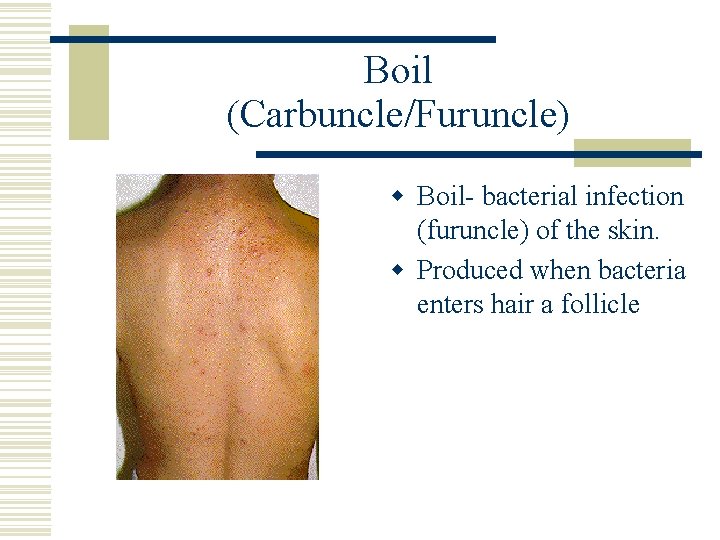 Boil (Carbuncle/Furuncle) w Boil- bacterial infection (furuncle) of the skin. w Produced when bacteria