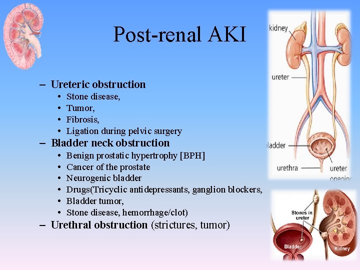 Post-renal AKI – Ureteric obstruction • • Stone disease, Tumor, Fibrosis, Ligation during pelvic
