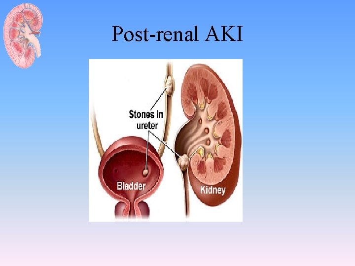 Post-renal AKI 