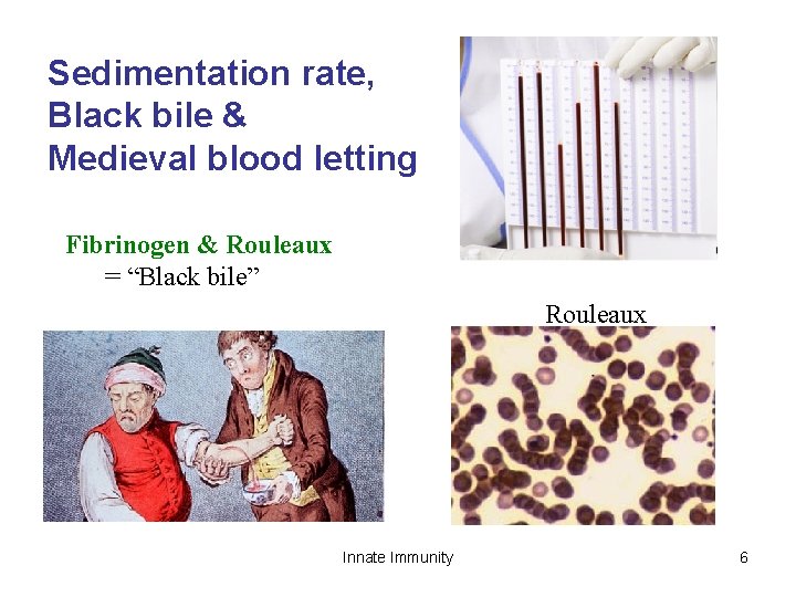 Sedimentation rate, Black bile & Medieval blood letting Fibrinogen & Rouleaux = “Black bile”