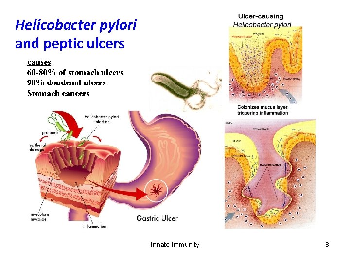 Helicobacter pylori and peptic ulcers causes 60 -80% of stomach ulcers 90% doudenal ulcers