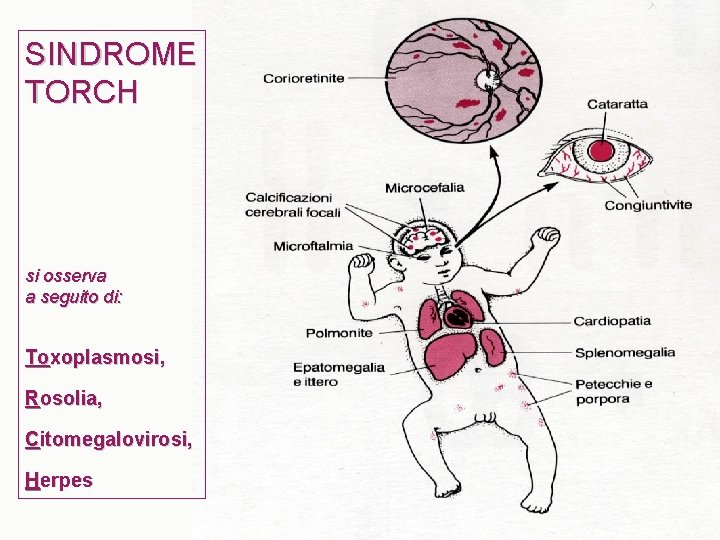 SINDROME TORCH si osserva a seguito di: Toxoplasmosi, Rosolia, Citomegalovirosi, Herpes 