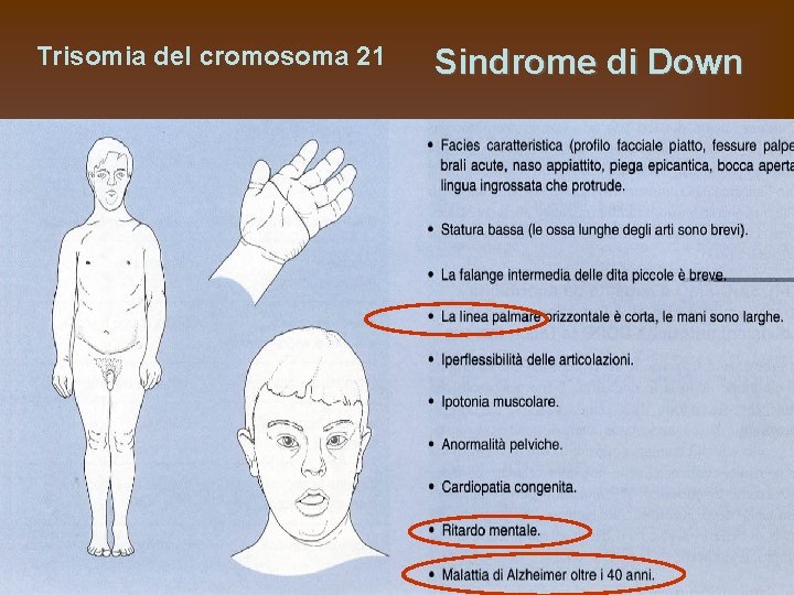 Trisomia del cromosoma 21 Sindrome di Down 