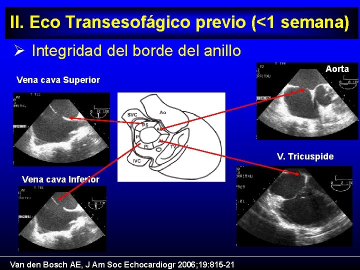 II. Eco Transesofágico previo (<1 semana) Ø Integridad del borde del anillo Aorta Vena