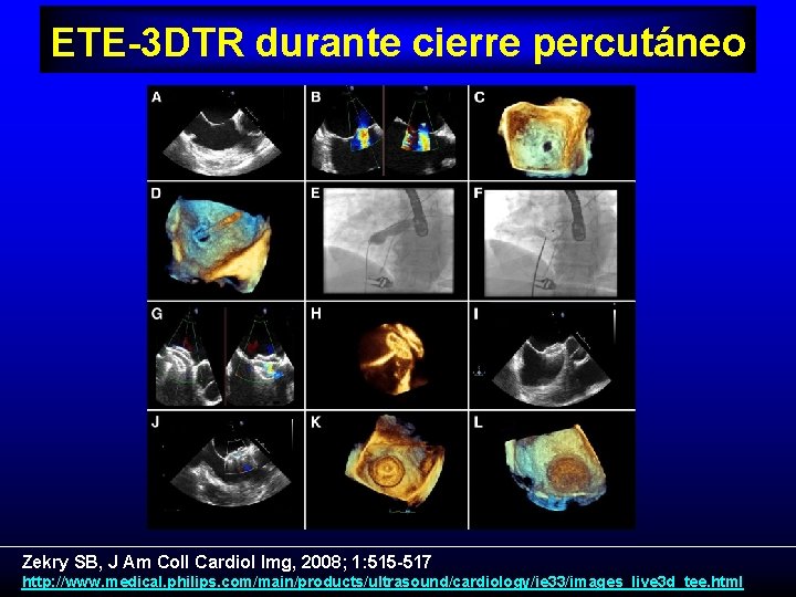 ETE-3 DTR durante cierre percutáneo Zekry SB, J Am Coll Cardiol Img, 2008; 1: