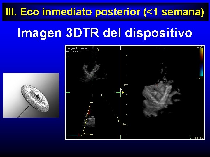 III. Eco inmediato posterior (<1 semana) Imagen 3 DTR del dispositivo 