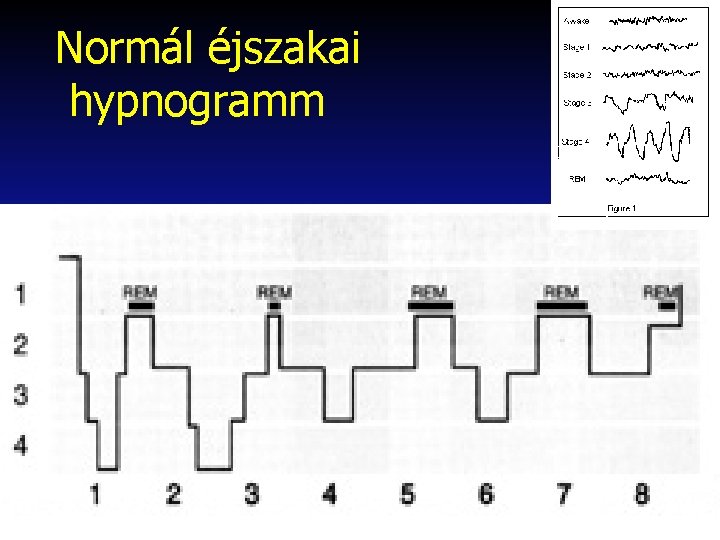 Normál éjszakai hypnogramm 