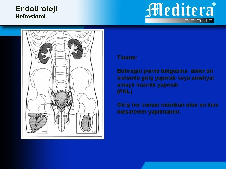 Endoüroloji Nefrostomi Tanımı: Böbreğin pelvis bölgesine delici bir sistemle giriş yapmak veya ameliyat amaçlı