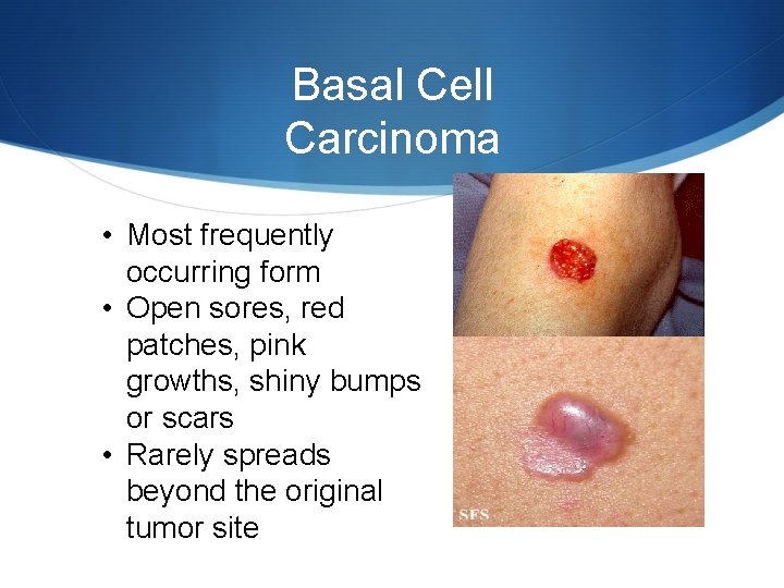 Basal Cell Carcinoma • Most frequently occurring form • Open sores, red patches, pink