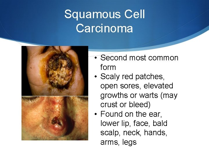 Squamous Cell Carcinoma • Second most common form • Scaly red patches, open sores,