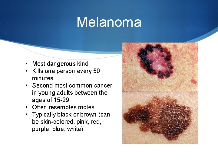 Melanoma • Most dangerous kind • Kills one person every 50 minutes • Second