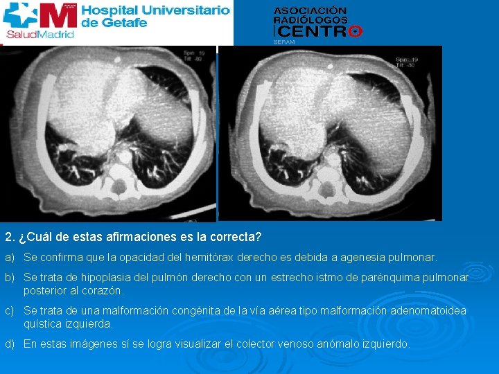 2. ¿Cuál de estas afirmaciones es la correcta? a) Se confirma que la opacidad