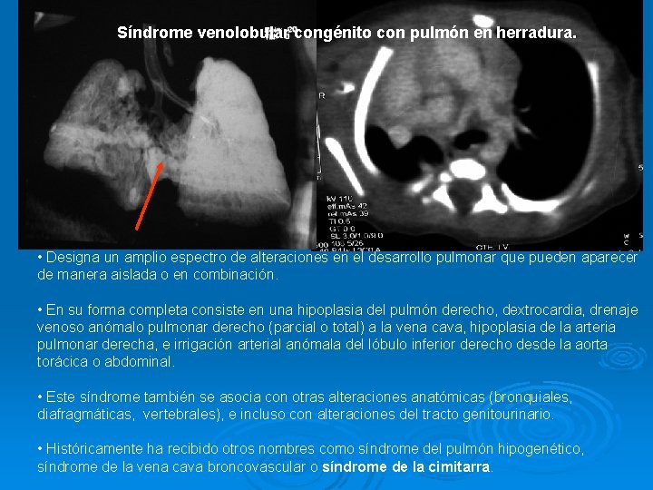 Síndrome venolobular congénito con pulmón en herradura. • Designa un amplio espectro de alteraciones