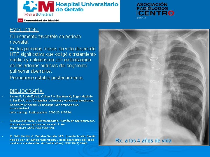 EVOLUCIÓN: Clínicamente favorable en periodo neonatal. En los primeros meses de vida desarrolló HTP