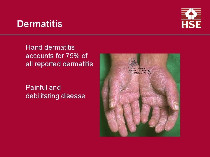 Dermatitis Hand dermatitis accounts for 75% of all reported dermatitis Painful and debilitating disease
