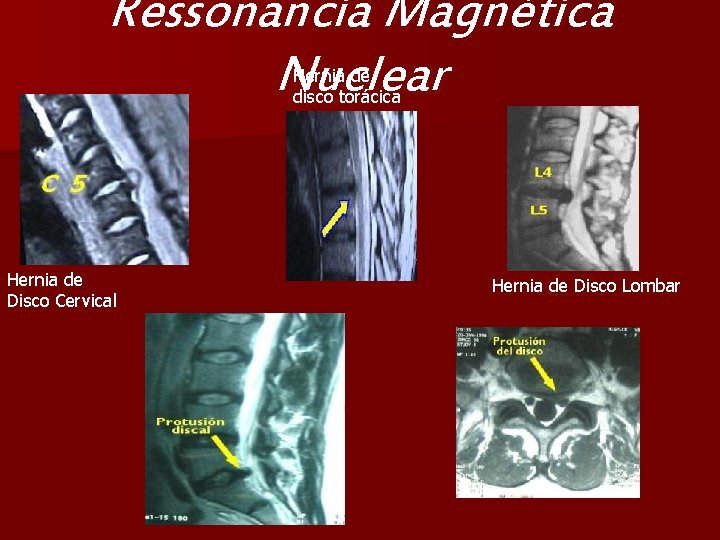 Ressonancia Magnética Nuclear Hernia de disco torácica Hernia de Disco Cervical Hernia de Disco