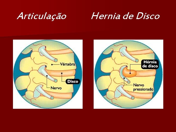 Articulação Hernia de Disco 