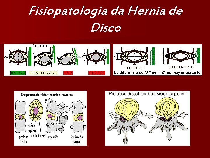Fisiopatologia da Hernia de Disco 