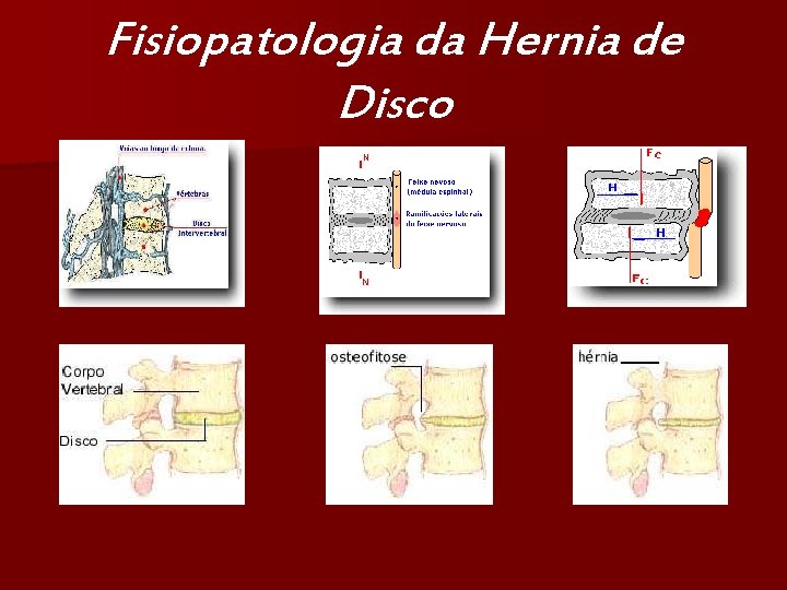 Fisiopatologia da Hernia de Disco 