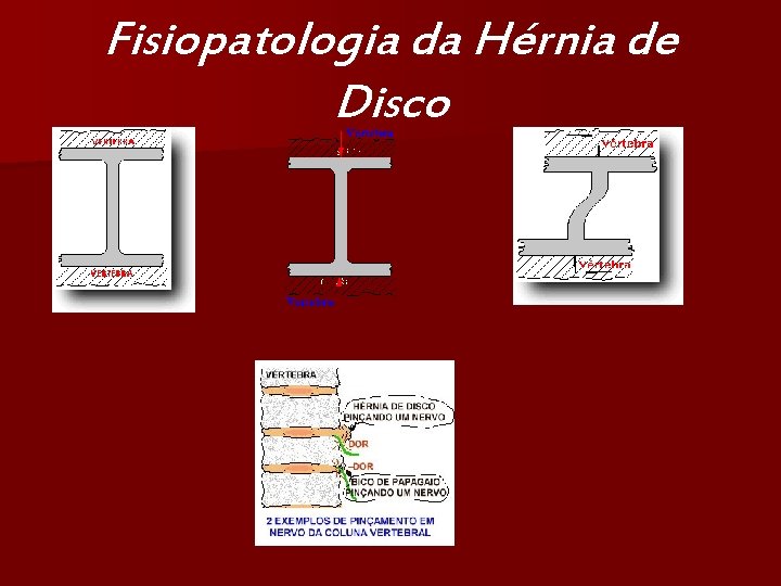 Fisiopatologia da Hérnia de Disco 