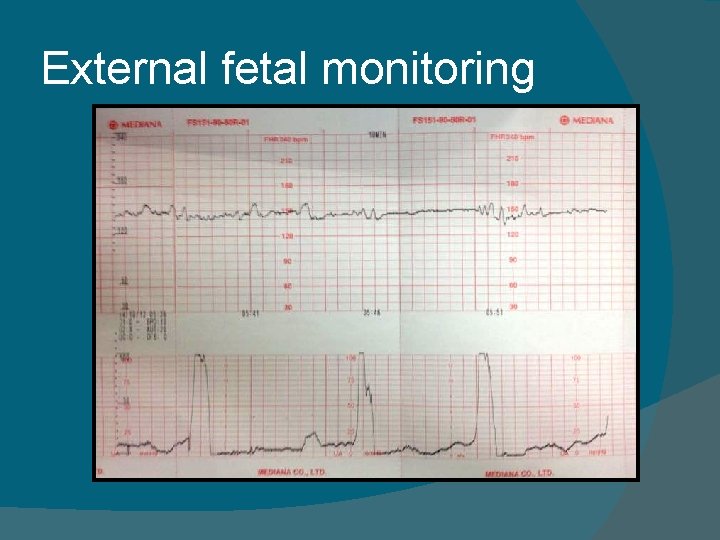 External fetal monitoring External fetal monitoring