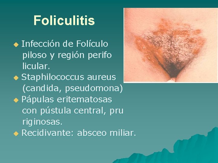 Foliculitis Infección de Folículo piloso y región perifo licular. u Staphilococcus aureus (candida, pseudomona)