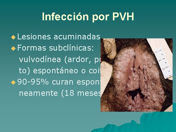 Infección por PVH u Lesiones acuminadas. u Formas subclínicas: vulvodínea (ardor, pruri to) espontáneo