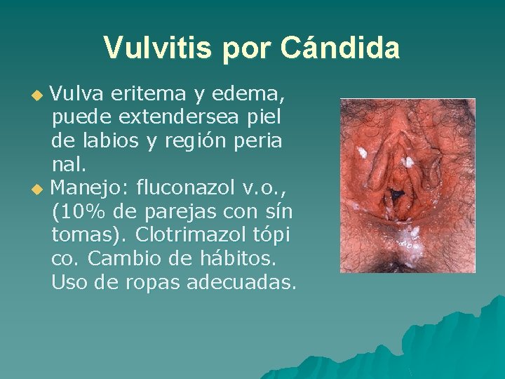 Vulvitis por Cándida Vulva eritema y edema, puede extendersea piel de labios y región