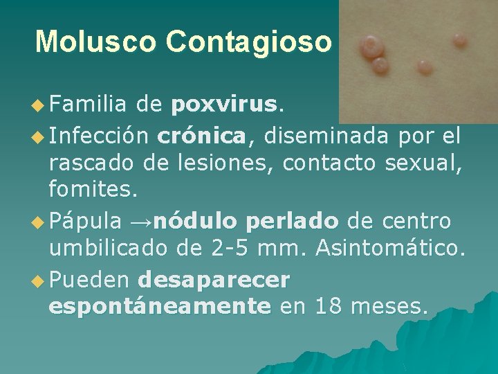 Molusco Contagioso u Familia de poxvirus. u Infección crónica, diseminada por el rascado de