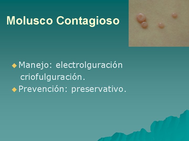 Molusco Contagioso u Manejo: electrolguración criofulguración. u Prevención: preservativo. 