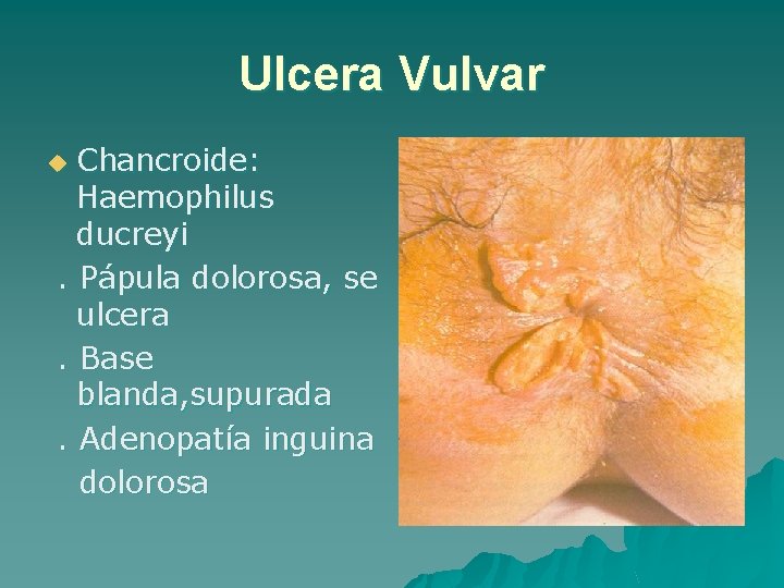 Ulcera Vulvar Chancroide: Haemophilus ducreyi. Pápula dolorosa, se ulcera. Base blanda, supurada. Adenopatía inguina