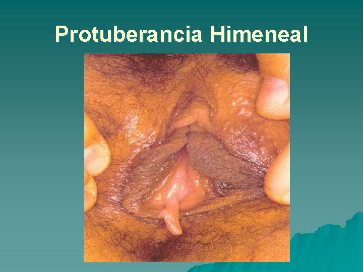 Protuberancia Himeneal 