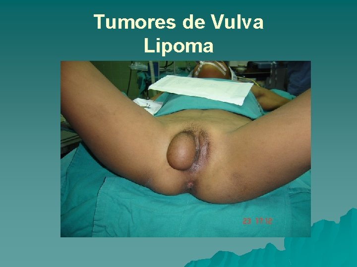 Tumores de Vulva Lipoma 