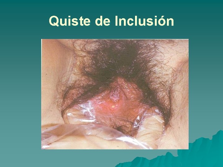 Quiste de Inclusión 