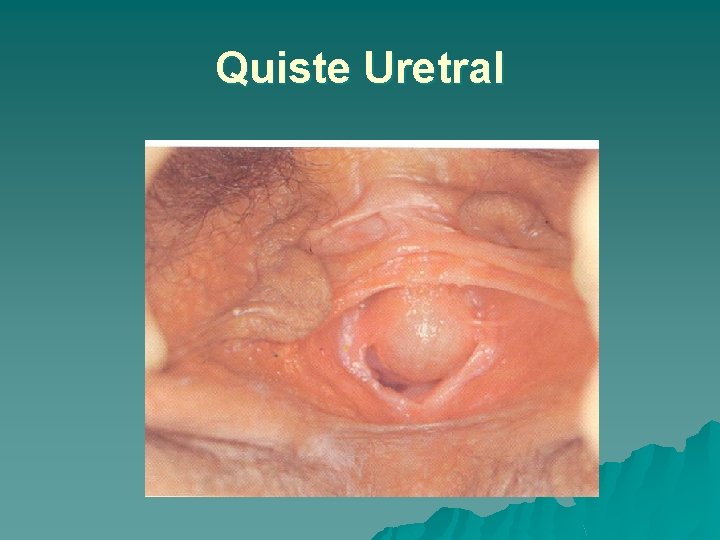 Quiste Uretral 