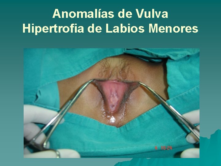 Anomalías de Vulva Hipertrofia de Labios Menores 