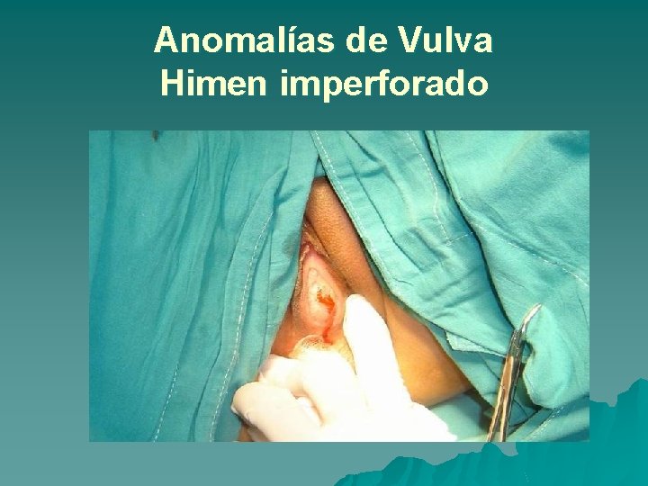 Anomalías de Vulva Himen imperforado 