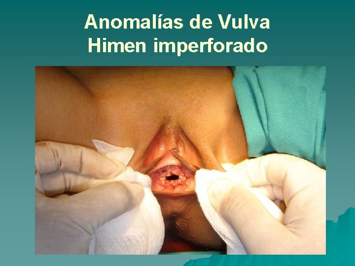 Anomalías de Vulva Himen imperforado 