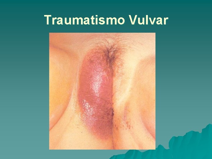 Traumatismo Vulvar 