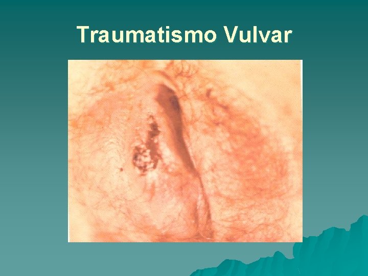 Traumatismo Vulvar 