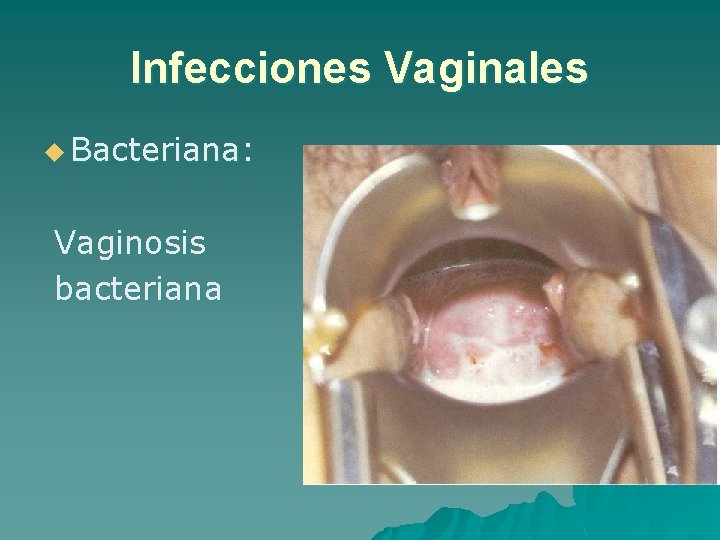 Infecciones Vaginales u Bacteriana: Vaginosis bacteriana 