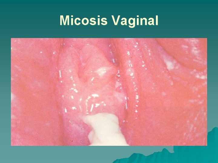 Micosis Vaginal 